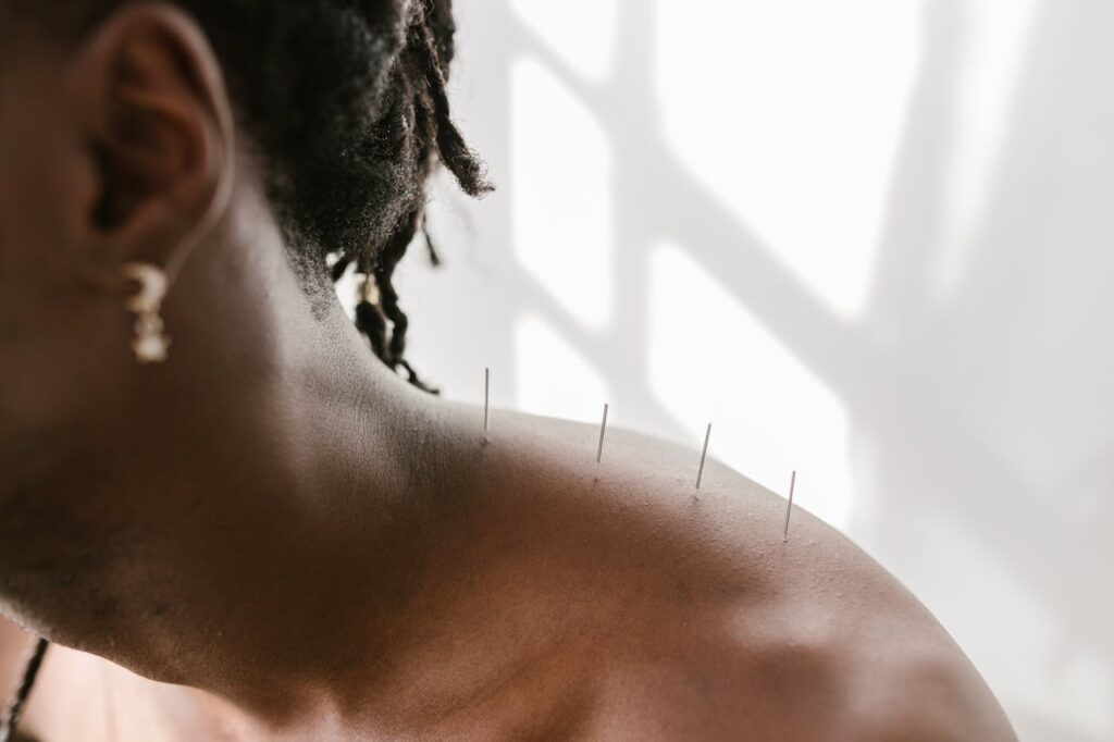Acupuncture shoulder Shoulder Pain Acupunctre